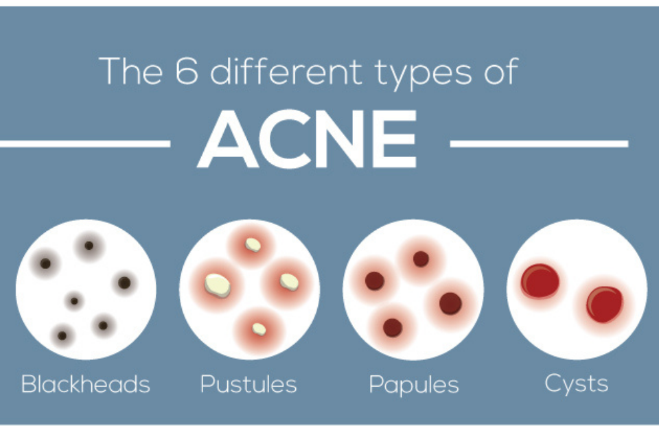 6 Types of Acne – Glowbar Skin Education