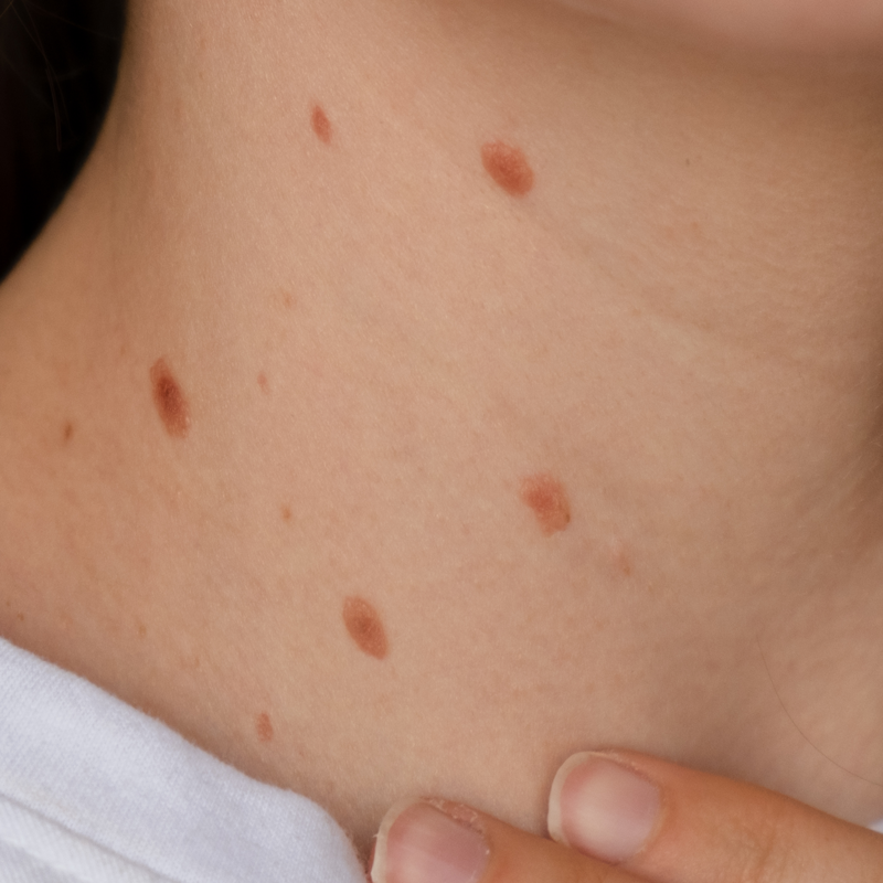 Woman Showing Birthmarks – Skin Concern Closeup